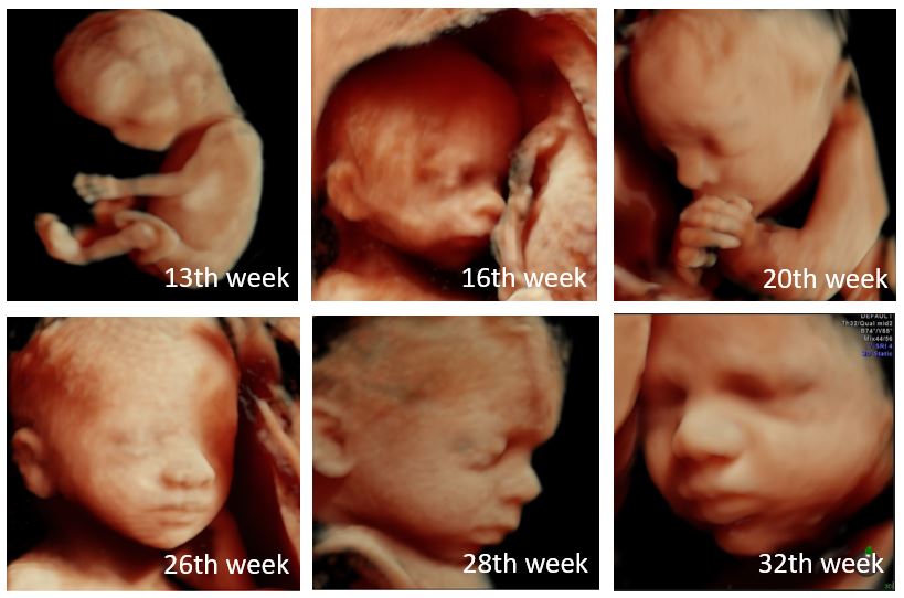 3D 4D Pregnancy Ultrasound Scan